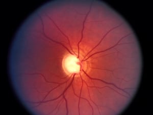 Превенция на оксидативния стрес с ненамаляващи вътреочното налягане средства при пациенти с глаукома