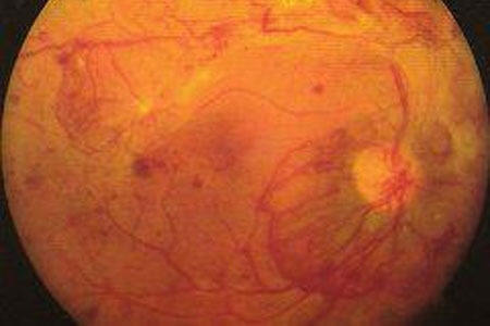 Диабетната ретинопатия
