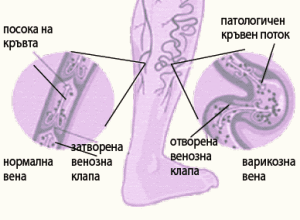 Хронична венозна недостатъчност и Ентан