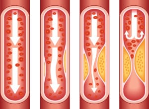 Атеросклероза: виновен е холестеролът