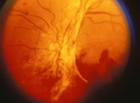 Диабетната ретинопатия