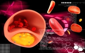 Тромбоза на дълбоките вени – същност
