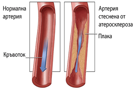 хронична артериална недостатъчност