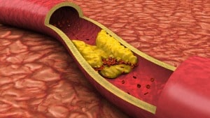 Периферна артериална болест – нов подход за лечение