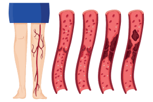 Мезентериална тромбоза – причини, симптоми, защита