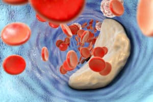 Атеросклероза и артериосклероза – разлики и прилики