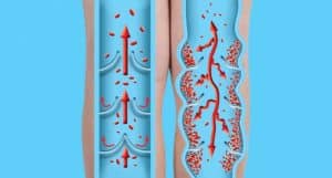 Хронична венозна недостатъчност – причини и лечение