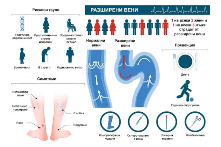 Разширени вени - топ 5 причини