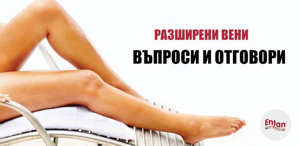 Често задавани въпроси за разширени вени
