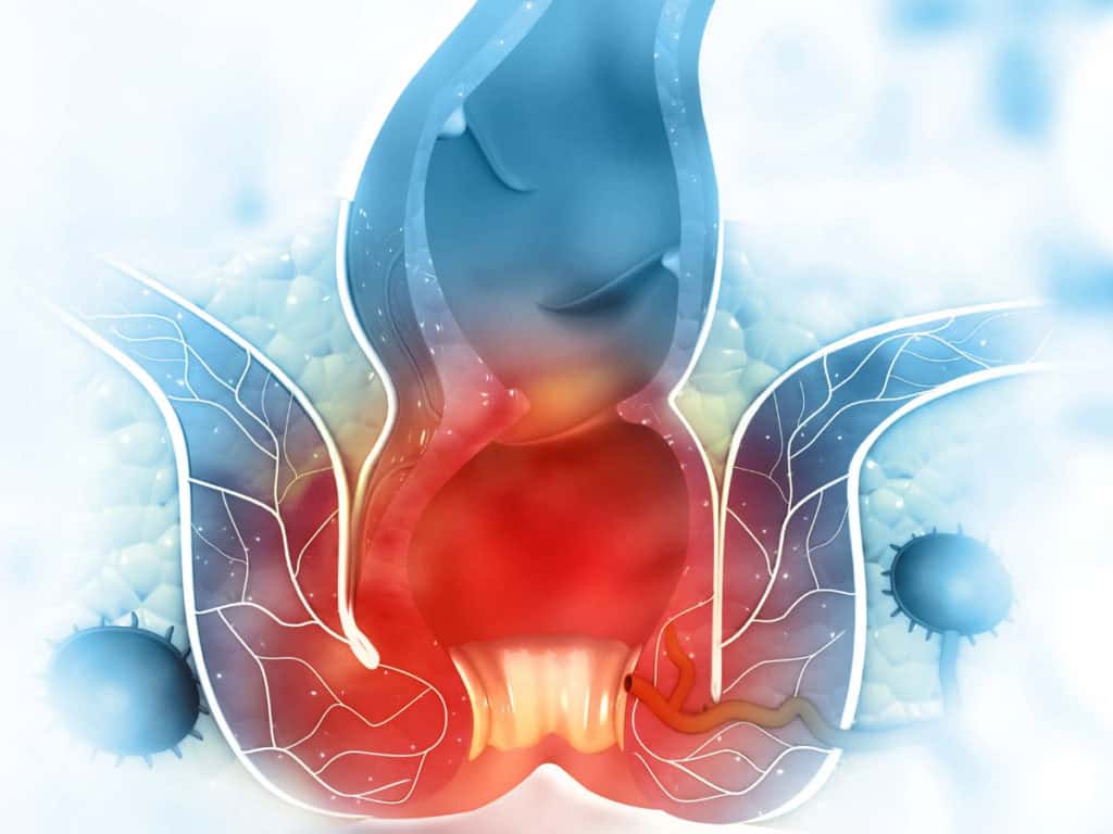 болка от хемороиди