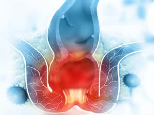 Болка от хемороиди – как да се справим с проблема?