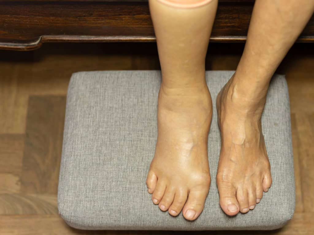 Първи признаци на венозна недостатъчност